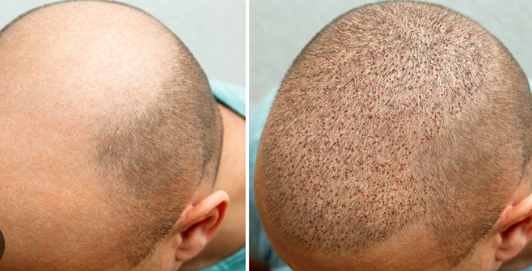 Hair Transplant